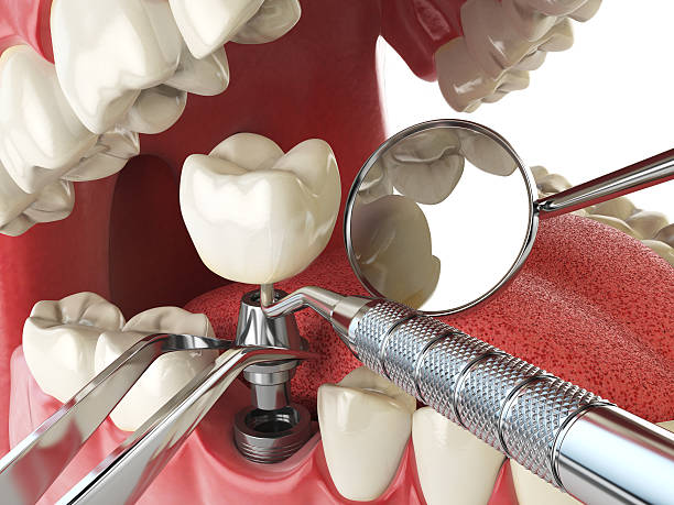 Best Emergency Tooth Extraction in Mount Ivy, NY